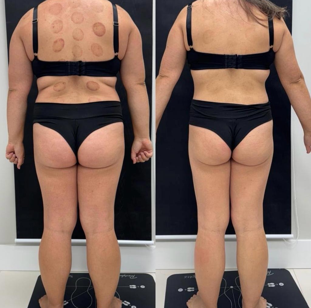 Caso 03 — Posterior